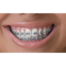 Adesivo Cola Braquetes + Acldo Ortodontico - Fixador Dental Foto mini 4