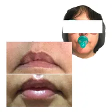 Copo Ventosa Silicone Antirrugas Celulite Flacidez Kit Com 3 Foto mini 4