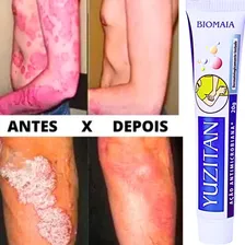 Creme PsorÃase Dermatite Alergia Coceira Com Vermelhidão Foto mini 2