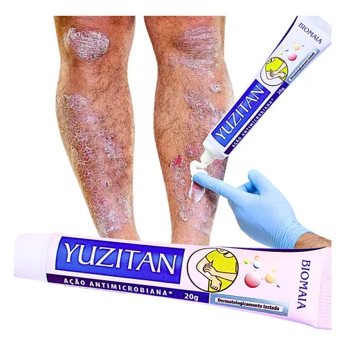 Creme PsorÃase Dermatite Alergia Coceira Com Vermelhidão Foto 1