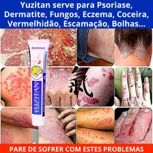 Creme PsorÃase Dermatite Alergia Coceira Com Vermelhidão Foto mini 3