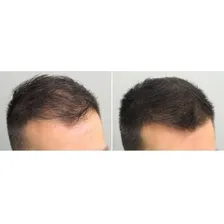Instant Hair Plus Castanho Médio 300ml Foto mini 3