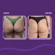 Kit 3 Bumbum Cream 200g - Creme Para Celulite e Estrias Foto mini 3