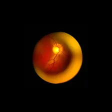 Oftalmosc贸pio Digital Indireto Eyescope Md Bivolt Foto mini 4