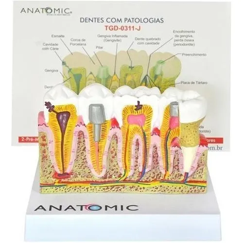 Patologia Dentária E Placa Explicativa Em 2 Partes, Anatomia Foto 1