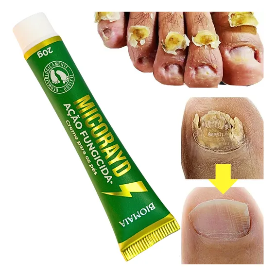 Pomada Creme Antimicótica Micose Unha Fungos Unhas Já Foto 1