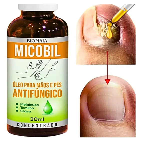 Remedio Que Tira Micose De Unha Mata Fungo Unha Mùos/pés Cor Preto Foto 1