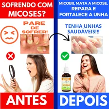 Remedio Que Tira Micose De Unha Mata Fungo Unha Mùos/pés Cor Preto Foto mini 2