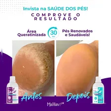 Removedor Amolecedor De Calos Rachaduras E Cutículas Procalo Foto mini  3