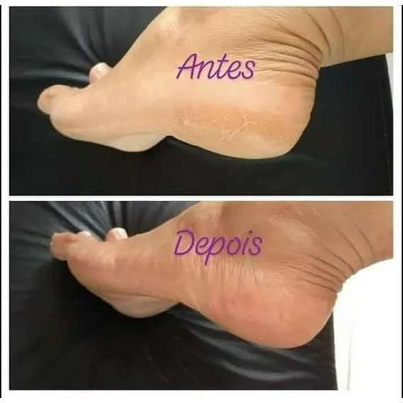 Repos Amaciante CutÃculas E Calosidades 900ml Foto 1